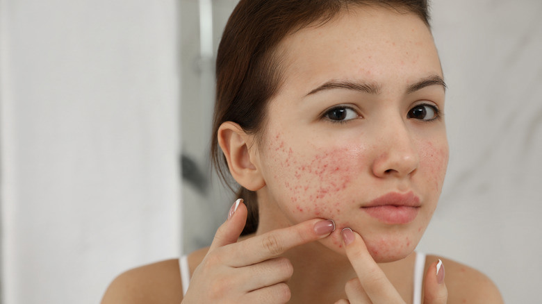 Get Clear Skin with Acne Treatments in Dubai