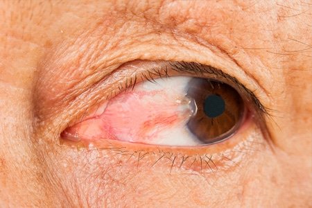 The Current Advances in Vision Laser Surgery