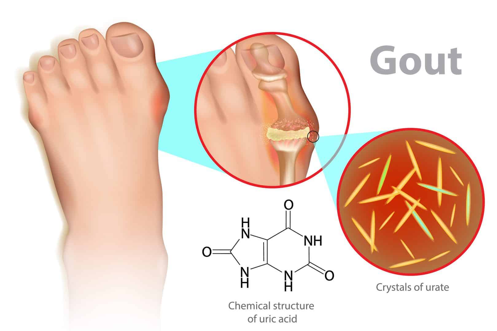 What Are the Best Uric Acid Tests for Vegans? Avoiding Plant-Based Pitfalls