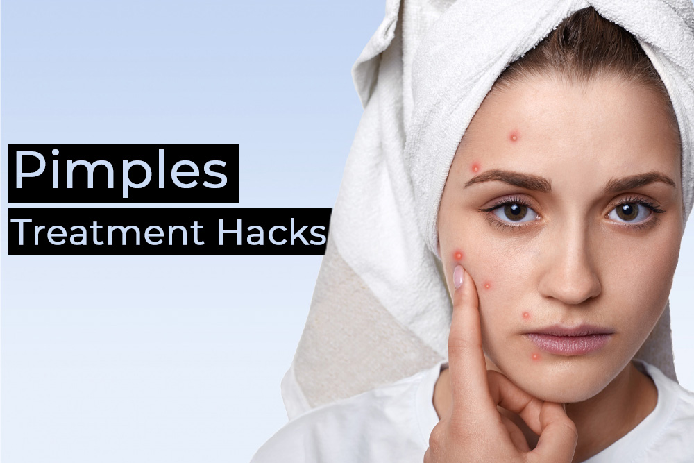 Ultimate Oily Skin And Pimples Treatment Hacks