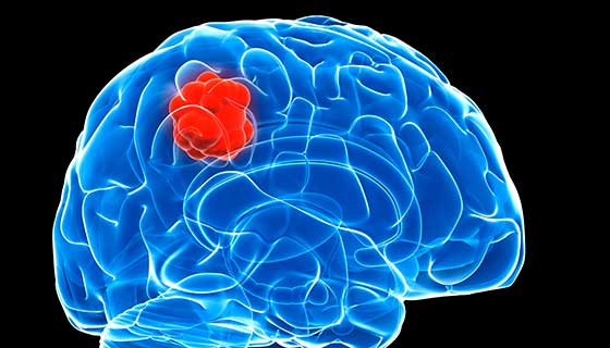 Glioblastoma Multiforme Treatment Market Share, Size, Industry Insights and Forecast 2023-2028