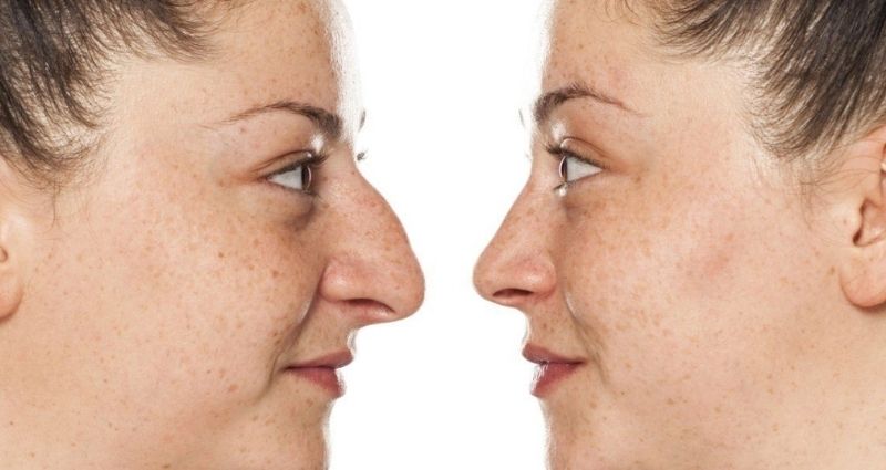 What Are The Potential Risks And Complications Of Rhinoplasty In Colombia?